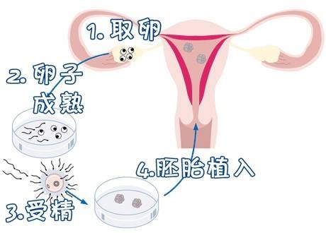 三代供卵试管选性别包生男孩